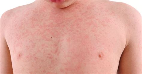 what does rash look like in meningitis